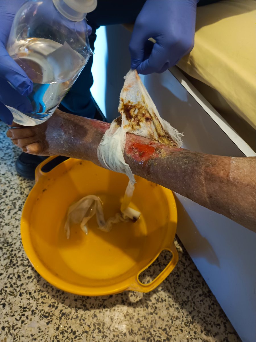 LuisReyes_30's tweet photo. Hoy le hicieron curas a María. Su pie está algo delicado. La situación de María es bastante delicada y es necesario llegar a algún ente del gobierno argentino (o venezolano) q la pueda ayudar. Apoyen difundiendo. 🙏
@MamaLisVzla @LuisOlavarrieta @CancilleriaARG 
#Mbappe
#Hawái https://t.co/daqIdKg2iD