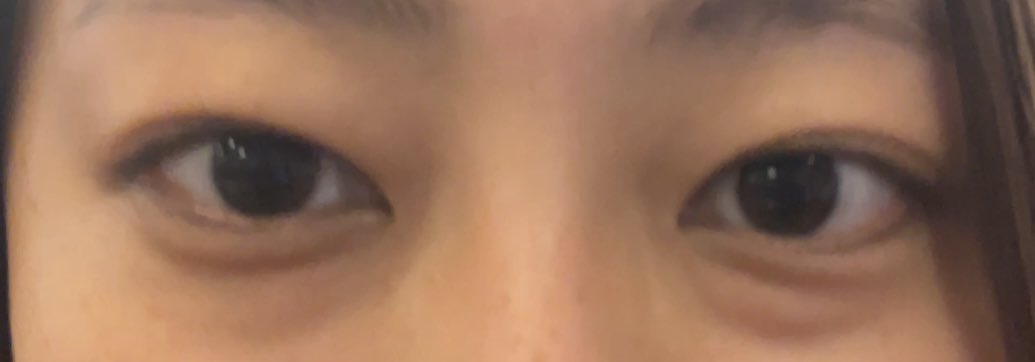 kgpki's tweet photo. 目の下のクマ取りやってきた😂
ずっと気にしてたので…
経過観察していく💊
やる前 https://t.co/yIEdAtgeL6