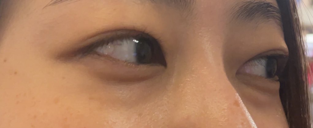 kgpki's tweet photo. 目の下のクマ取りやってきた😂
ずっと気にしてたので…
経過観察していく💊
やる前 https://t.co/yIEdAtgeL6