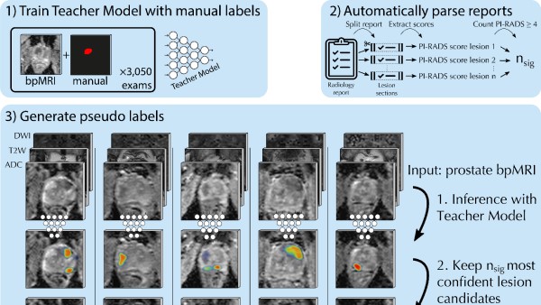 A novel semisupervised learning method leverages clinical reports to guide voxel-level labels doi.org/10.1148/ryai.2… <a href="/joeranbosma/">Joeran Bosma</a> @anindox8 <a href="/radboudumc/">Radboudumc</a> #SemisupervisedLearning #ProstateCancer #prostate