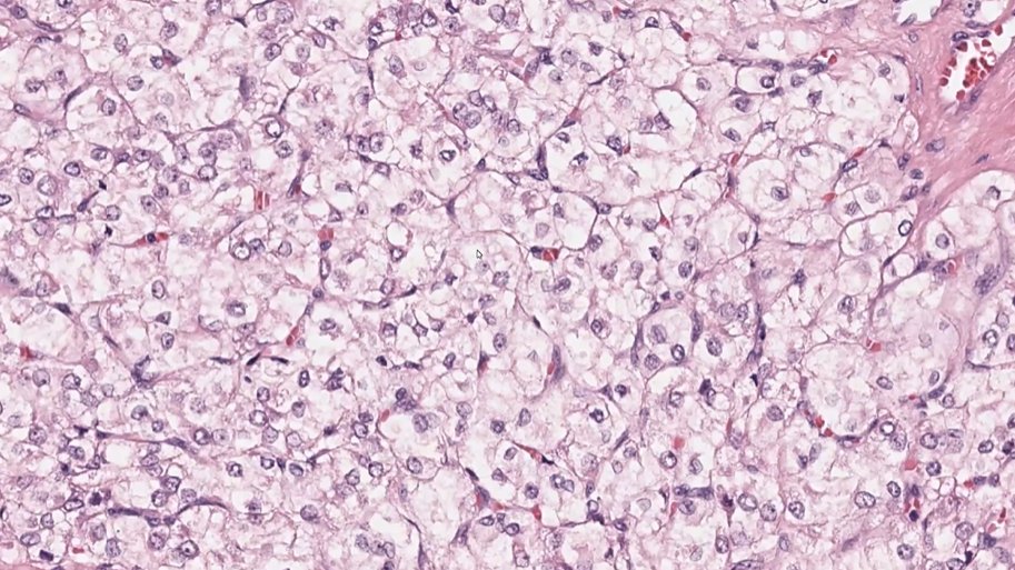 Ovary
Steroid cell tumor

Dr. Rabban #ISGyP #everydayGYN #GYNpath #pathology #pathologist #PathTwitter #PathX