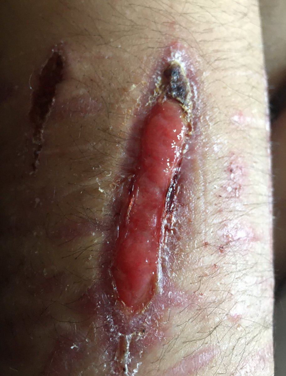 sh_aftercare's tweet photo. overgranulation
what is it ? and how to deal with it?
a short thread ! https://t.co/8IIcOJR9Hh