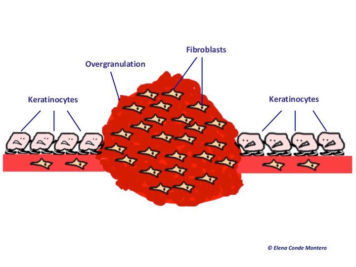 sh_aftercare's tweet photo. overgranulation
what is it ? and how to deal with it?
a short thread ! https://t.co/8IIcOJR9Hh