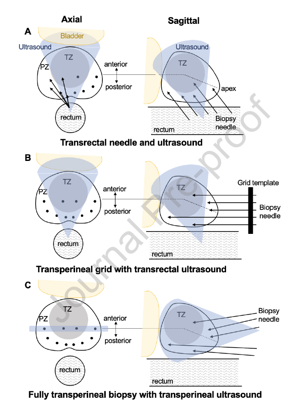 📢I am happy to share our new paper 'A novel MRI/ultrasound fusion prostate biopsy technique using transperineal ultrasound: An initial experience' sciencedirect.com/science/articl… 👍Congratulations to our Multi-Disciplinary Team #cancerresearch #prostatecancer #MedTwitter #teamscience