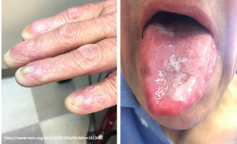 A 50 yo man p/w 2 months of cough & shortness of breath. Phys exam shows dysplastic nails & several white patches on tongue. His maternal uncle has similar nail findings & unexplained bone marrow failure. Labs show pancytopenia & short telomeres. What's the diagnosis?

#GeneChat