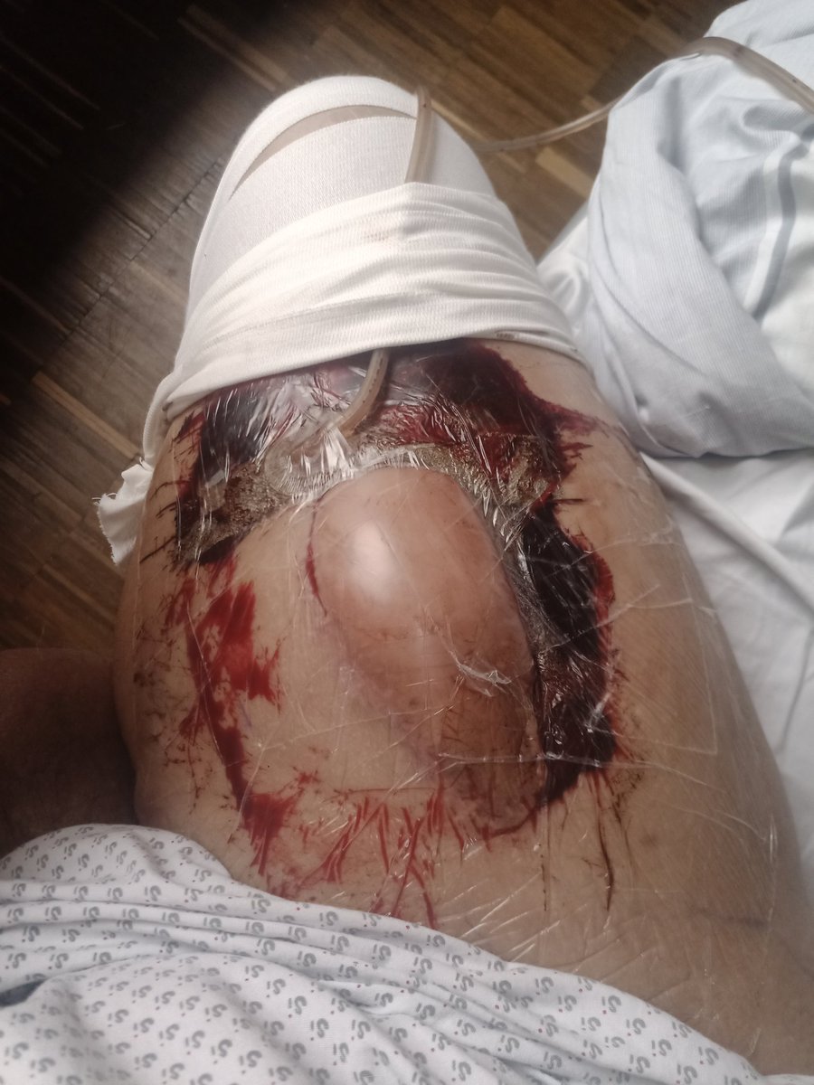 Looks like my leg had a brush with a combine harvester.