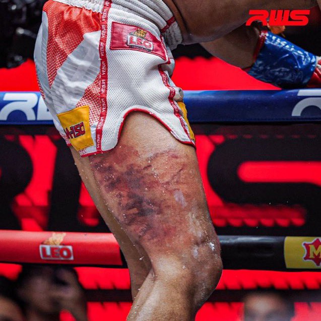 MMArena_'s tweet photo. Les kicks en Muay-Thai ! 💢

La jambe de Rungwittaya après 4 rounds contre Nadaka Yoshinari 🤯 https://t.co/Gj0zKhPEin