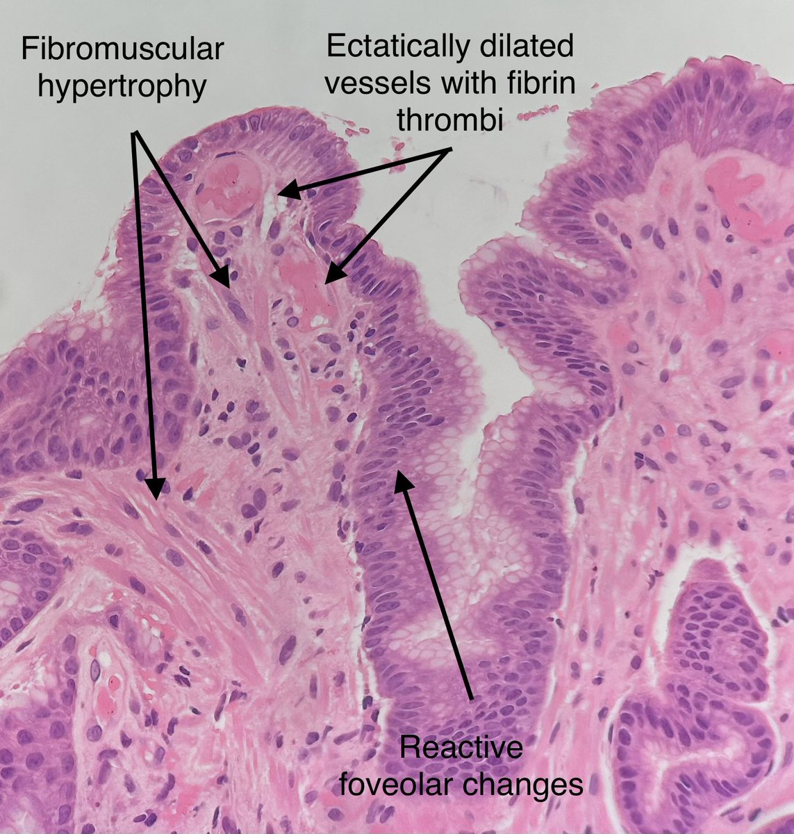 Nice example of gastric antral vascular ectasia (GAVE) today - in a person with classical “watermelon stomach” appearance on endoscopy (being investigated because of iron deficiency anaemia and probable malena). Thought I would share with you all 💁‍♀️🔬🤓 #GIpath #PathTwitter