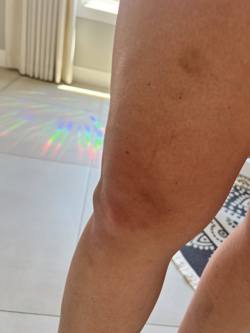 1 pic. Idk why’s happened after surgery but I have seen doctors and had blood work I’m not anemic.. i’m