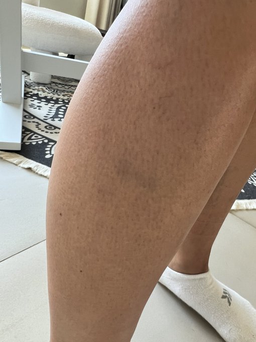 2 pic. Idk why’s happened after surgery but I have seen doctors and had blood work I’m not anemic.. i’m