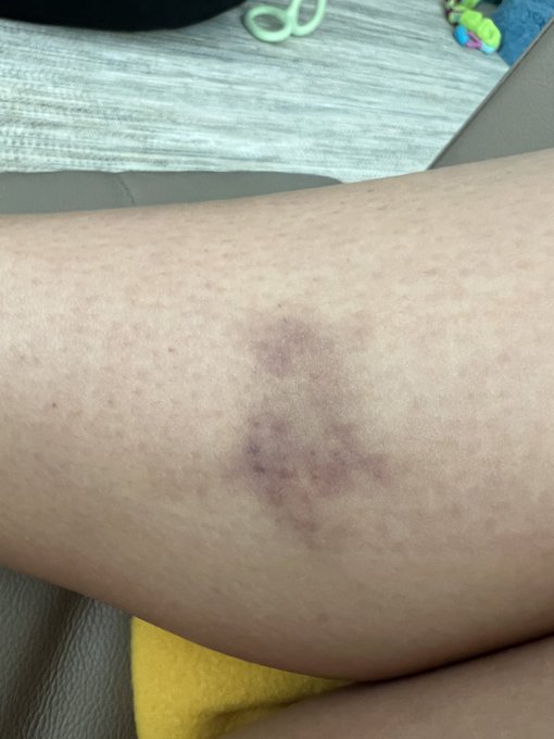 3 pic. Idk why’s happened after surgery but I have seen doctors and had blood work I’m not anemic.. i’m