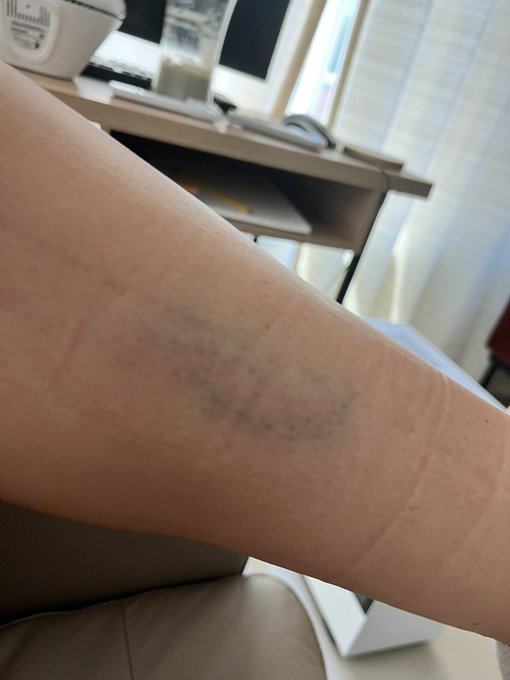 4 pic. Idk why’s happened after surgery but I have seen doctors and had blood work I’m not anemic.. i’m