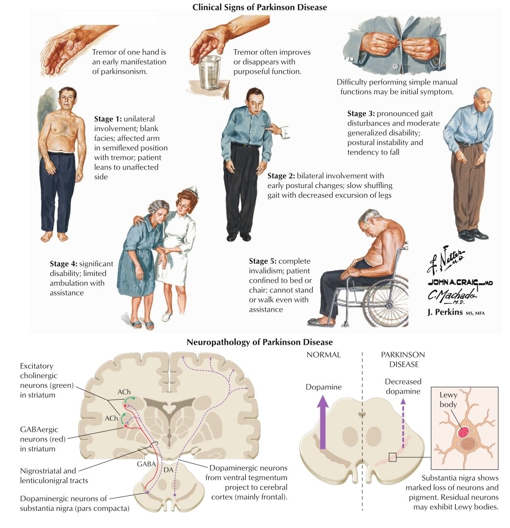 majedalhoriby's tweet photo. Clinical Signs of Parkinson Disease🥰👇 https://t.co/Wx2T7nfxSl