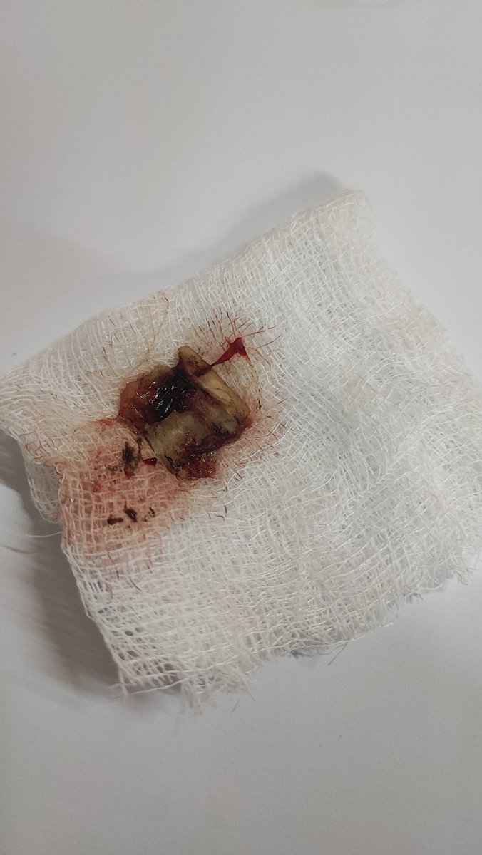 faizabibi5's tweet photo. "🇵🇰 Celebrating Independence Day with a medical twist! 🏥🩺 A brave 15-year-old faced a chicken bone challenge, leading to hematemesis 😨 But fear not! After a successful EGD rescue mission, the foreign intruder was evicted! 🪶 #OnCallDiaries #GITwitter #Residency #Responsibility https://t.co/Qi1GLz4O0X