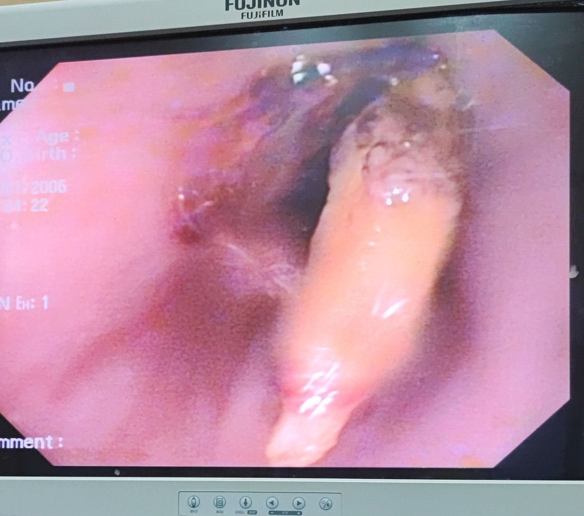 faizabibi5's tweet photo. "🇵🇰 Celebrating Independence Day with a medical twist! 🏥🩺 A brave 15-year-old faced a chicken bone challenge, leading to hematemesis 😨 But fear not! After a successful EGD rescue mission, the foreign intruder was evicted! 🪶 #OnCallDiaries #GITwitter #Residency #Responsibility https://t.co/Qi1GLz4O0X