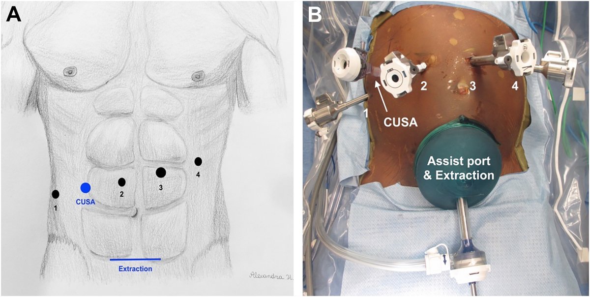 Our review on robotic hepatectomy for #HCC. With videos of course. 😎 

Link: authors.elsevier.com/a/1ha143lyy0qO…