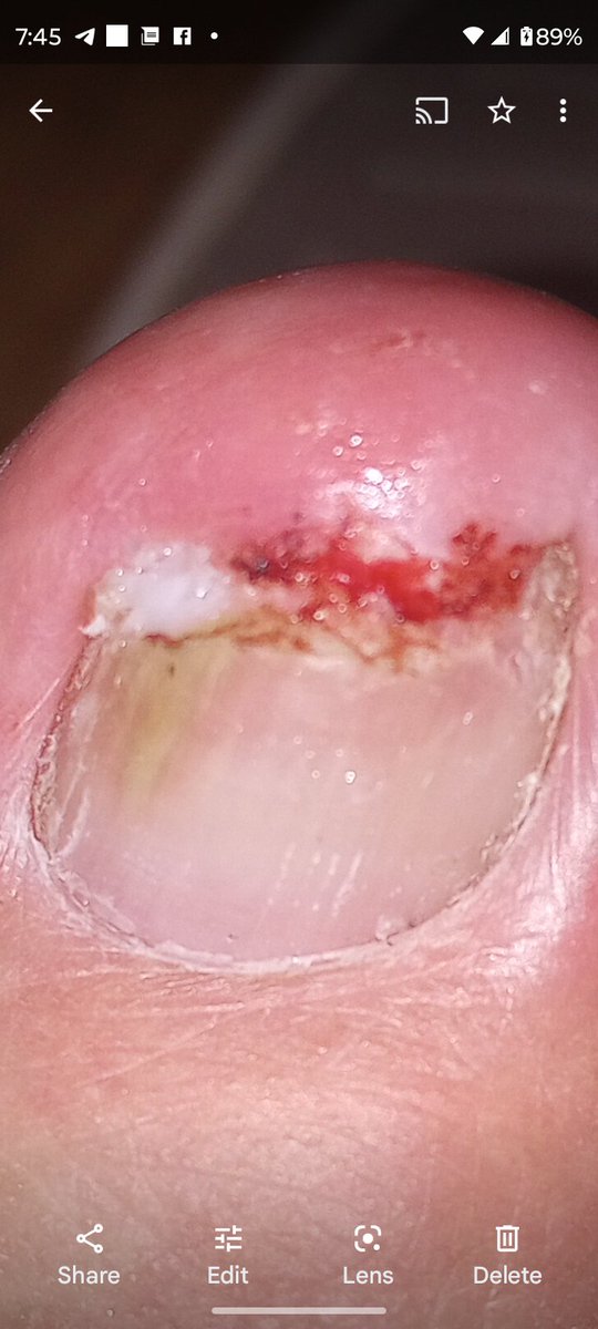 Michaelmullin77's tweet photo. Can you believe a man took a sturdy fly swatter and smacked  this toe as hard as he could because a fly was on it.  Oh it had a little spot of blood but nothing like this, broke it open even more. I didn't do anything to him. Time to move because the pain was so bad for 30 minute https://t.co/njmBFm20jp