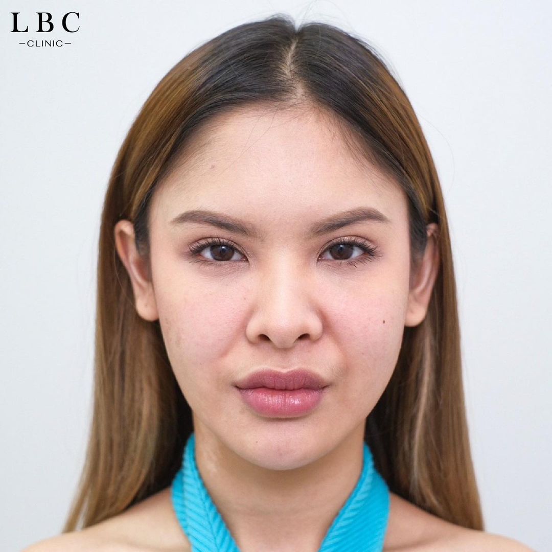LBCClinic's tweet photo. ร่องลึกข้างแก้ม หน้าเรียวไม่สะใจแก้ได้ค่ะ
ปัญหาเคสนี้ที่ชัดที่สุดคือบริเวณร่องแก้ม ที่ดูลึกเกิดจ��กทั้งการจัดฟัน อายุที่มากขึ้น คอลลาเจนน้อยลง กระดูยุบตัว คุณหมอประเมินให้ที่ 3 ซีซี 27,000 บาท + หน้าเรียวกระชับ Size XXL 13,900 บาท ไม่มีค่าใช้จ่ายเพิ่มเติมค่ะ https://t.co/lZZiKNnYPp