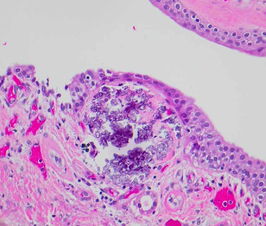 megothelioma's tweet image. My awesome attending pointed out this incidental sub-urothelial calcification in this RCC case. These are referred to as "Randall's plaques" are thought to be precursors to kidney stones.

#PathTwitter #GUPath  #urology