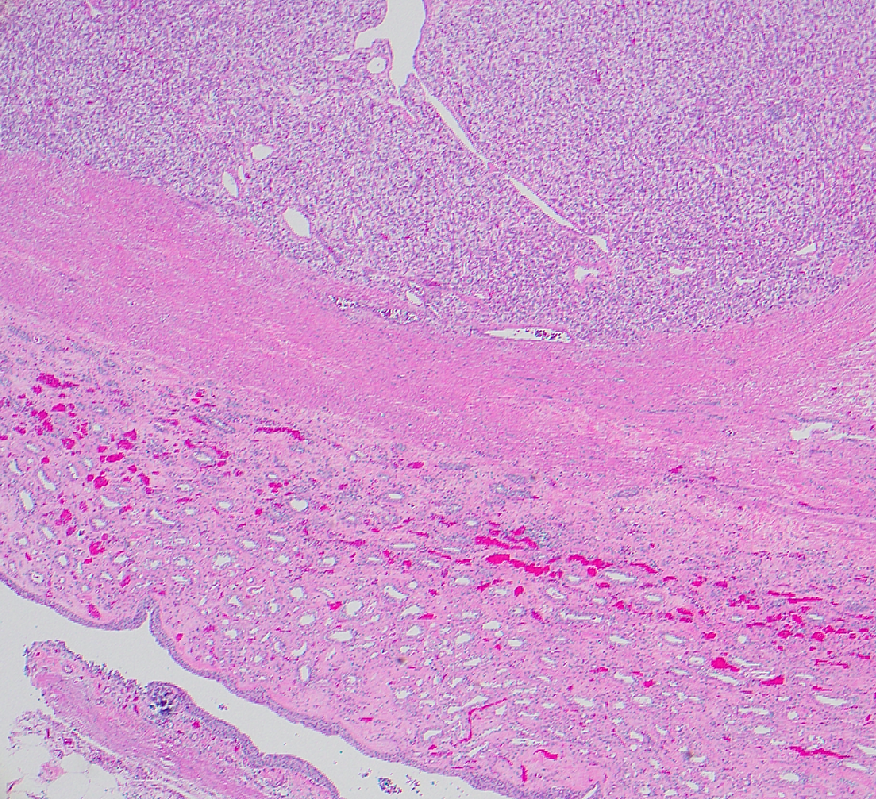 megothelioma's tweet image. My awesome attending pointed out this incidental sub-urothelial calcification in this RCC case. These are referred to as "Randall's plaques" are thought to be precursors to kidney stones.

#PathTwitter #GUPath  #urology