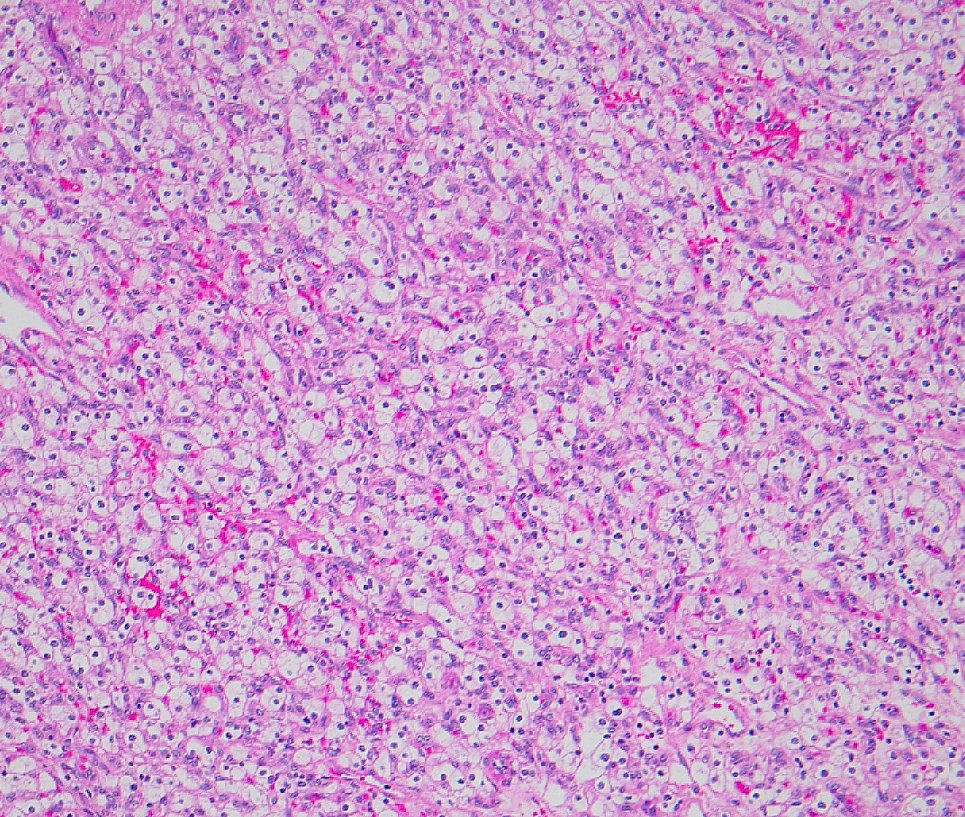 megothelioma's tweet image. My awesome attending pointed out this incidental sub-urothelial calcification in this RCC case. These are referred to as "Randall's plaques" are thought to be precursors to kidney stones.

#PathTwitter #GUPath  #urology