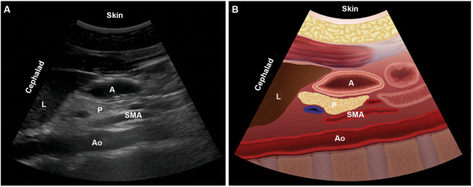 UniversalSurge1's tweet photo. #Gastric #Ultrasound Useful for #Risk #Assessment Before #Pediatric #Surgery 
Read more: https://t.co/T1ksqqenJc 
share your paper on: https://t.co/7f9IQq9XFt 
#ipjus 
#manuscript 
#reseach 
#Pediatric #Surgery https://t.co/vbWNUouGUB