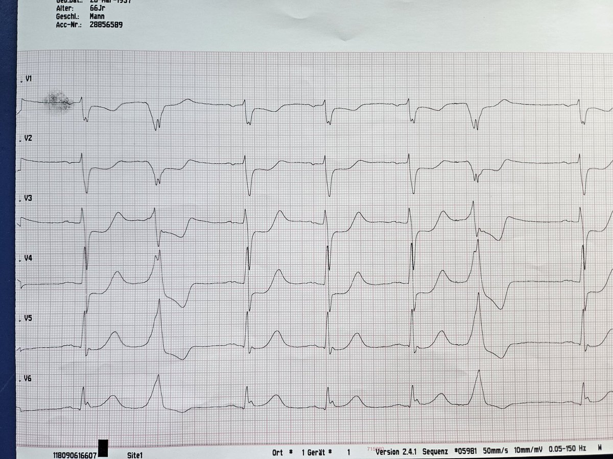 EP_BGM1's tweet photo. Ischaemia signs including pathognomonic VPB: cause? Remission due to...? https://t.co/xqG0JaVw6D