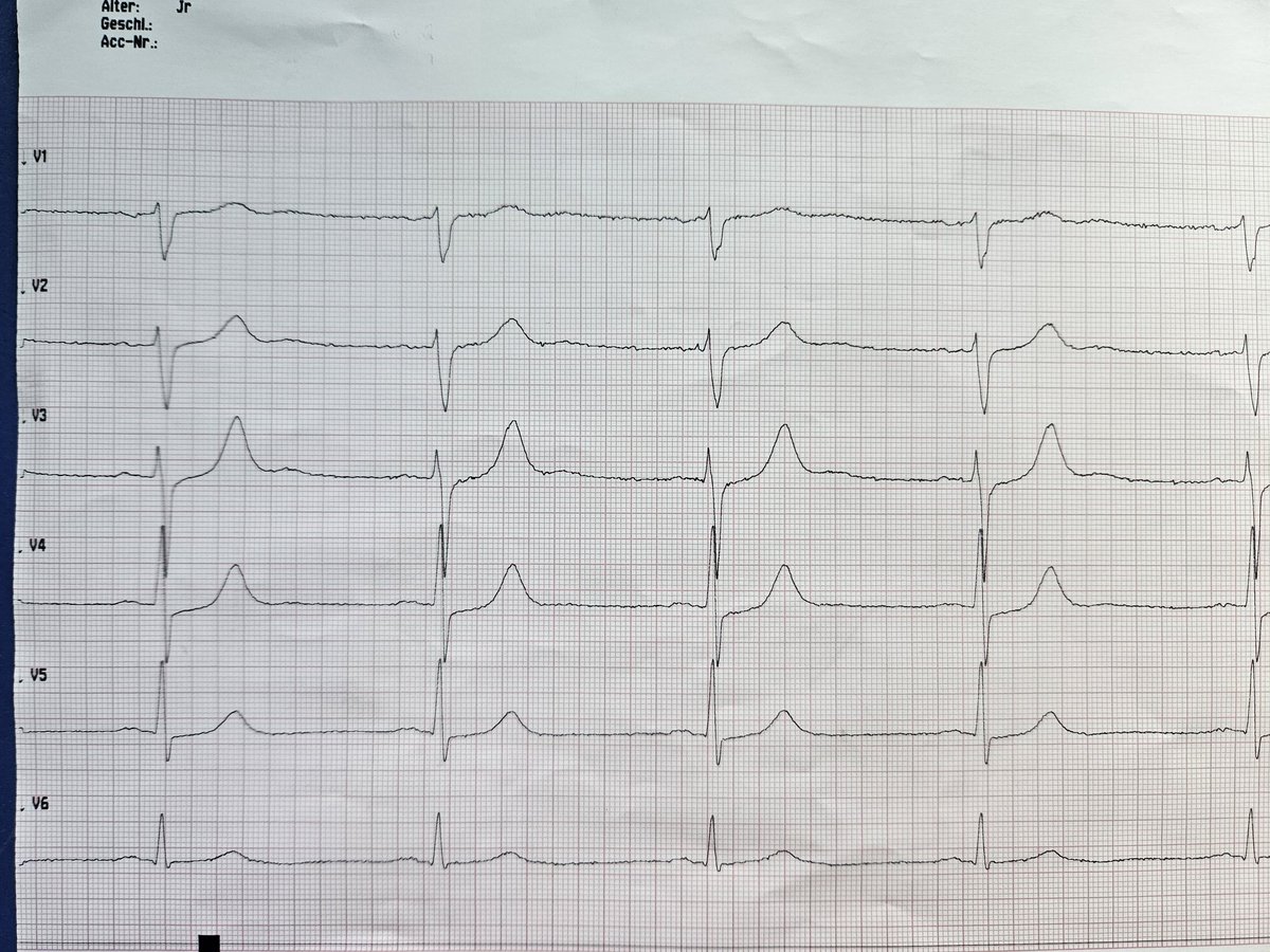 EP_BGM1's tweet photo. Ischaemia signs including pathognomonic VPB: cause? Remission due to...? https://t.co/xqG0JaVw6D