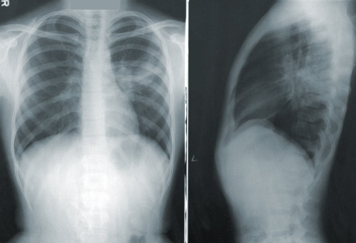 'Effects of Different Anticoagulation Doses on Moderate-to-Severe COVID-19 Pneumonia With Hypoxemia'

feedkast.com/feeds/757

#VTE