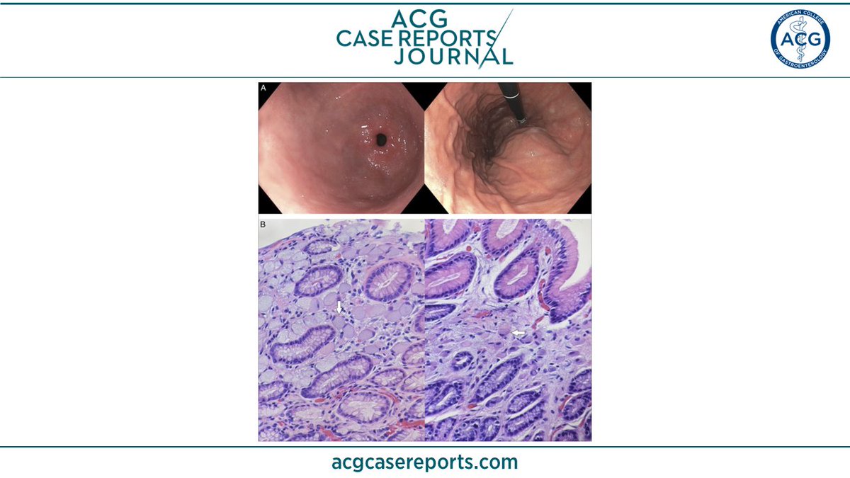 ACGCRJ's tweet photo. 🔎 ACG Case Reports Journal 🔍

Two Pediatric Cases Within a Familial Cluster and Hereditary Diffuse Gastric Carcinoma: A Tale of 2 Sisters
Lacey Falgout, MD &amp; Lawrence L. Gensler, MD
👉 https://t.co/BlDapgFwos

@LaceyFalgout #GItwitter #GIfellows @KhushbooSGala @VibhuC_MD https://t.co/eAy0leuZqY