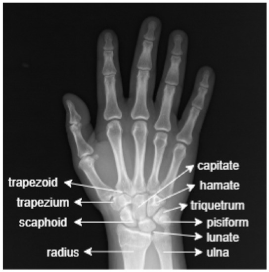 Sensors_MDPI's tweet photo. #highlycitedpaper
Fracture Detection in Wrist X-ray Images Using Deep Learning-Based Object Detection Models
https://t.co/i333wYaxzr
#ObjectDetection #ArtificialIntelligence #BiomedicalImageProcessing #DeepLearning #Xray https://t.co/LikAbyu6w5