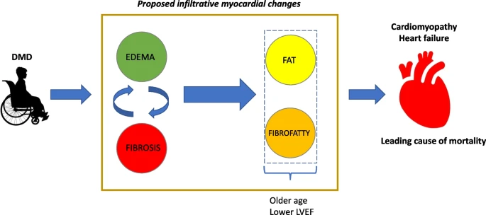 Check out our work using CMR to noninvasively understand the progression of myocardial changes in DMD cardiomyopathy @VUMCResearch