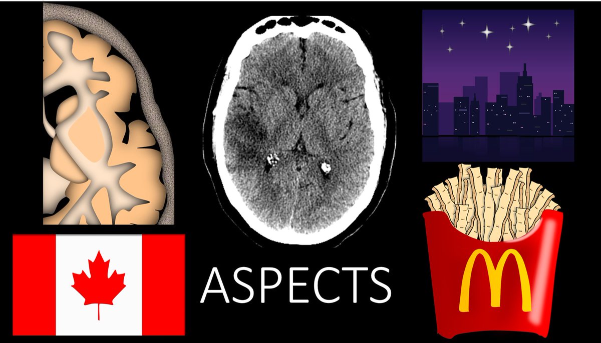 teachplaygrub's tweet photo. 1/One important aspect to stroke care is well, ASPECTS!

Here’s a #tweetorial to help you remember this basic #STROKE scoring system.

#medtwitter #FOAMed #FOAMrad #medstudenttwitter #medstudent #neurorad #radiology #radres #neurology #Neurosurgery #CT #meded  #neurotwitter https://t.co/LnJSEmmOYX