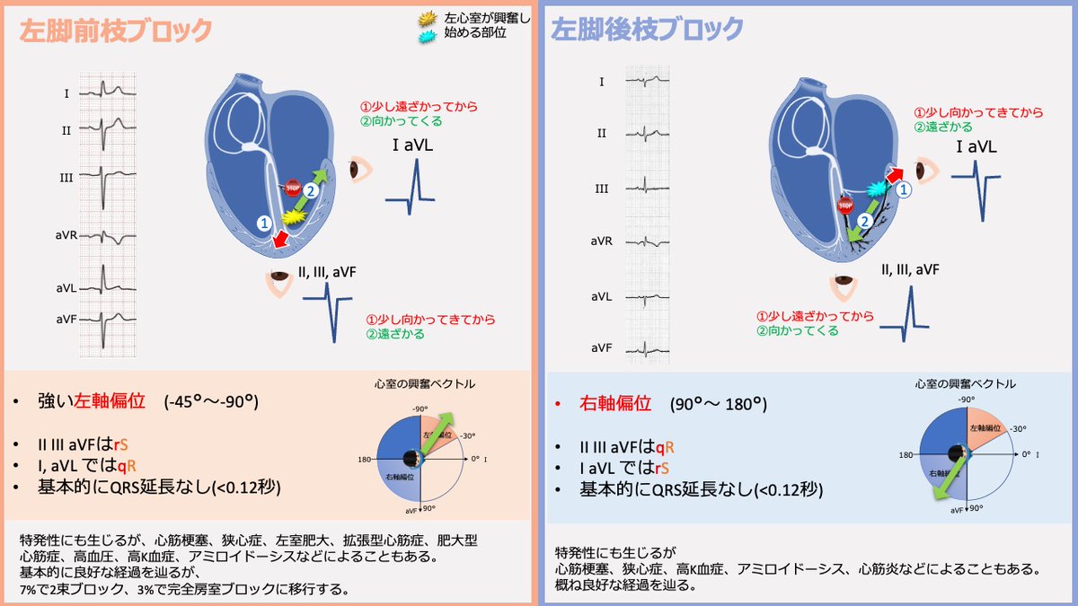 MichifumiTokuda's tweet photo. 心電図検定に必ず出る脚ブロック🫀

左脚前枝ブロック・・・左軸偏位
左脚後枝ブロック・・・右軸偏位

に何故なるのかわからないという方のため、理由を簡単にまとめてみました🤗

#EP大学
#心電図検定 https://t.co/L6uFVAmBD5