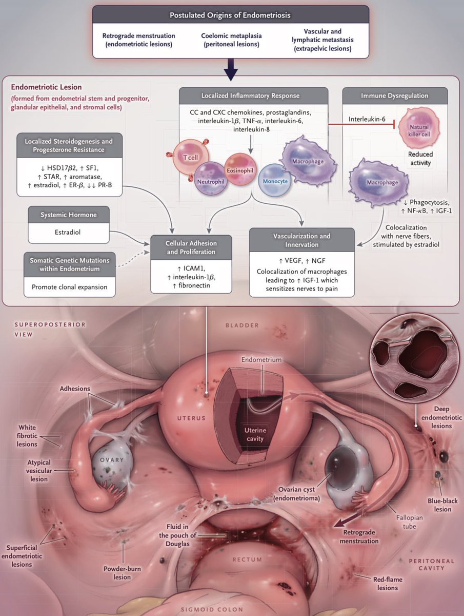 AdvReproduction's tweet image. Endometriosis

#TipsForNewDocs #MedEd #MedTwitter #medicine #medical #medicare #health #healthcare #FOAMed #ClinicalPearl #clinicaltips #MedStudents

Credit: @NEJM