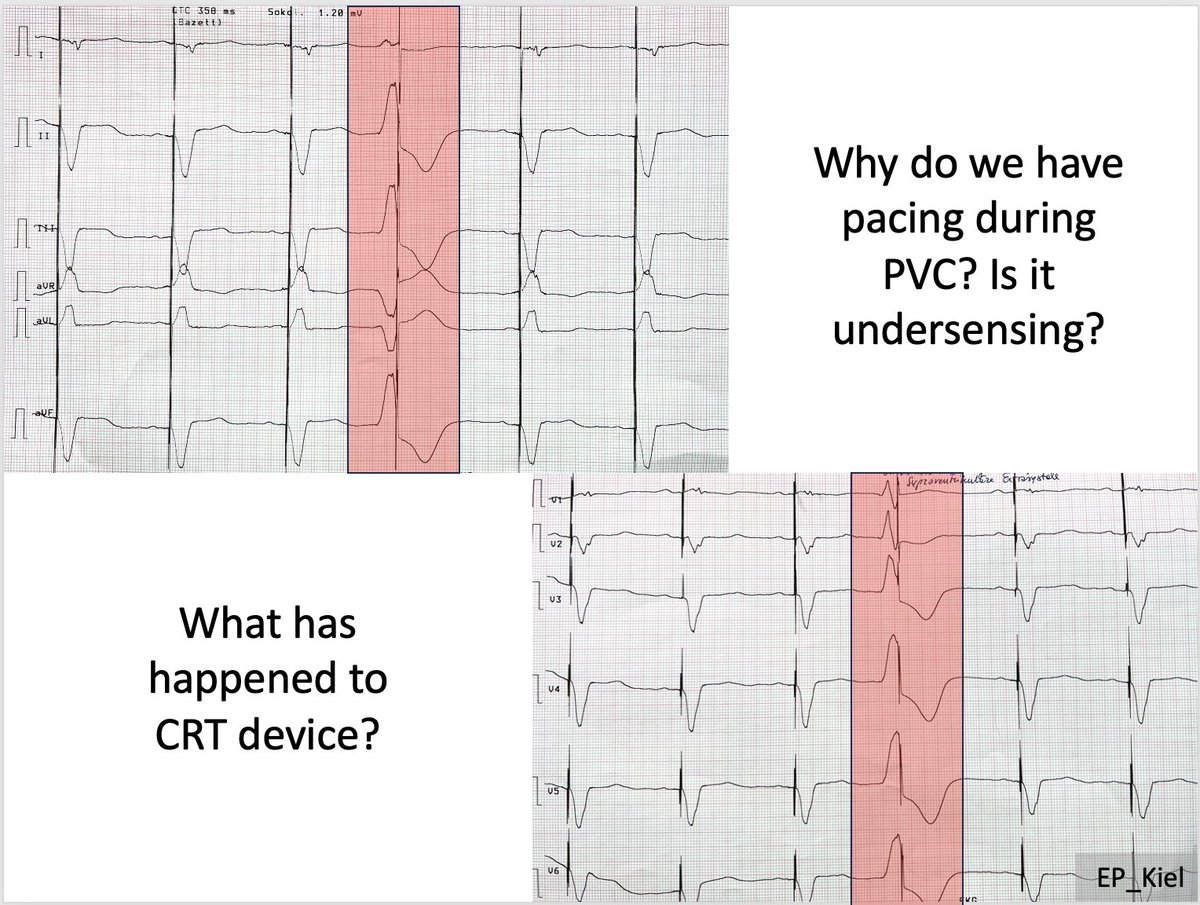 70 yo patient with implanted CRT-P device due to ischemic cardiomyopathy with reduced LVEF. At follow-up following ECG.#EPeeps  Why do we have this pacing spike in PVC?<a href="/evgeny_lyan/">Evgeny Lian</a> <a href="/ThomasDemming/">Thomas Demming</a> #EP_Kiel #CardioTwitter #CardioEd