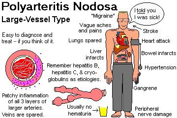 nursingahead's tweet photo. Polyarteritis Nodosa : 

التهاب الشريان العقدي المتعدد هو عبارة عن التهاب جدران الشرايين الصغيرة والمتوسطة الحجم بسبب خلل في جهاز المناعة حيث ينتفخ الشريان أحياناً لدرجة التمزق ويصبح تالفاً. 

من اعراضه : تصبغ في جلد أصابع اليدين والقدمين باللون الأزرق أو الأحمر، كما قد تظهر بعض التقرحات الجلدية.