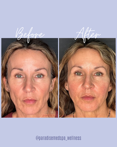 MyRenuva's tweet photo. These beautiful results are courtesy of the #Renuva elite injectors at Paradise Medspa &amp; Wellness.

Renuva is all about restoring your natural, youthful appearance. The result is refreshed, beautiful, subtle – and never overdone. 💜✨

📷 @paradisemedspa_wellness https://t.co/37i1JHr0ae