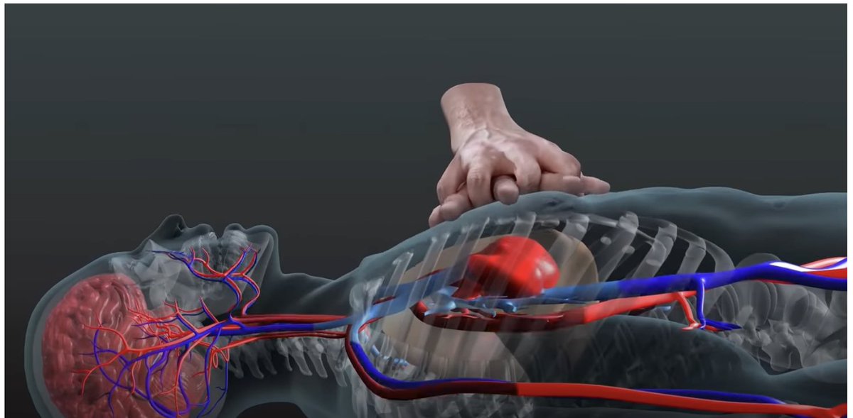 W ostatnich dniach trafiło do nas dwóch chorych  po ulicznym zatrzymaniu krążenia (sklep, siłownia). Obudzili się tego samego dnia bez szwanku. Wspaniałe!
Żyją, bo do zatrzymania krążenia doszło przy świadkach, którzy nie bali się podjąć resuscytacji.

Pamiętaj - jak nie jesteś