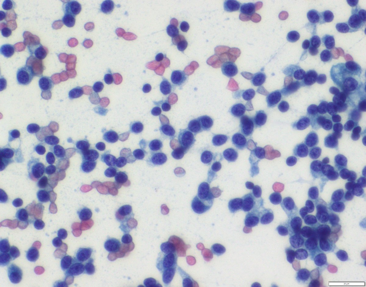 UpstateCytology's tweet photo. 65 yo male with LLL lung mass. What is your differential? What stains do you want to order? https://t.co/evqw54AAjn