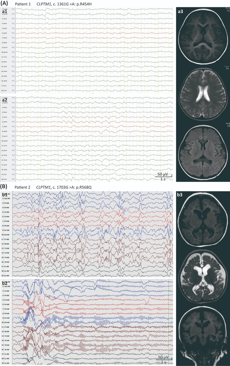 EpilepsiaJourn's tweet image. De novo CLPTM1 variants with reduced GABAAR current response in patients with epilepsy
doi.org/10.1111/epi.17…

#epilepsy #exomesequencing #lossoffunction #channelopathy #translational #CLPTM1variants #GABAAR #epilepsyresearch #ILAE  @IlaeWeb @epilepsiajourn @WileyNeuro