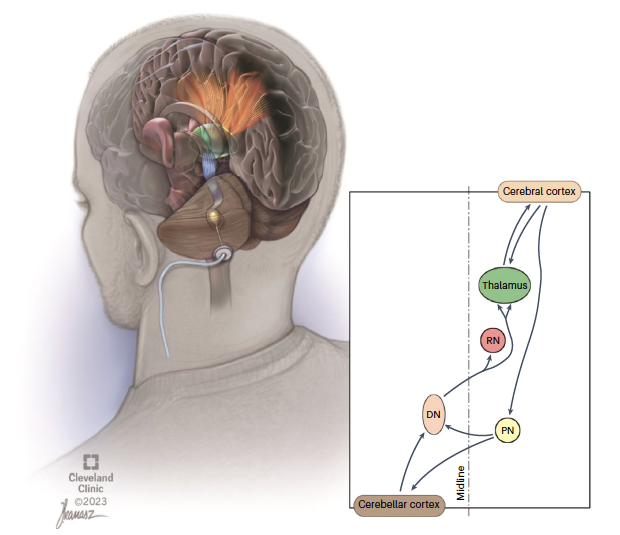 Deep Brain Stimulation to treat stroke. Andre Machado and Ken Baker and colleagues @ClevelandClinic in a new @NatureMedicine paper showed dentate nucleus stimulation was effective for a small pilot cohort of folks. Who were they? 'Individuals with a first-time, unilateral,