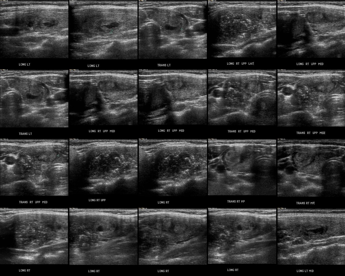 KoiosMed's tweet photo. How long would it take you to classify and dictate a 4 nodule #thyroid ultrasound exam?
#MedTwitter #radiology #radiologist #endocrinologist #endocrinology #ai #mdchat #hcsm #hcldr https://t.co/Yhq0fN77zn