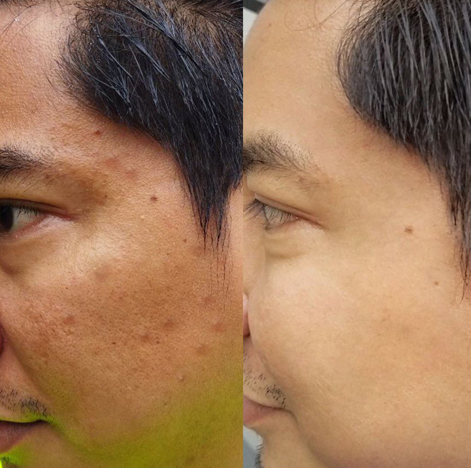 Goodbye Bekas Jerawat, Kusam &amp; Kulit Berminyak!

Khusus Cowok🔥

–a thread