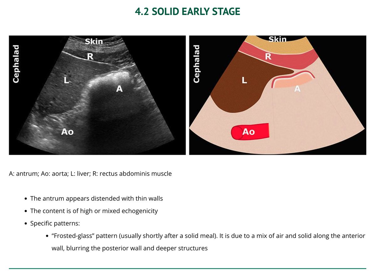 Gastric #POCUS is a great answer to the GLP-1 issue of delayed gastric emptying in pre-op It can also help reduce aspiration risk for ER providers performing urgent/emergent procedures Here's what to look for from gastricultrasound.org How-to do it: youtu.be/Zxt-JFvPQpM