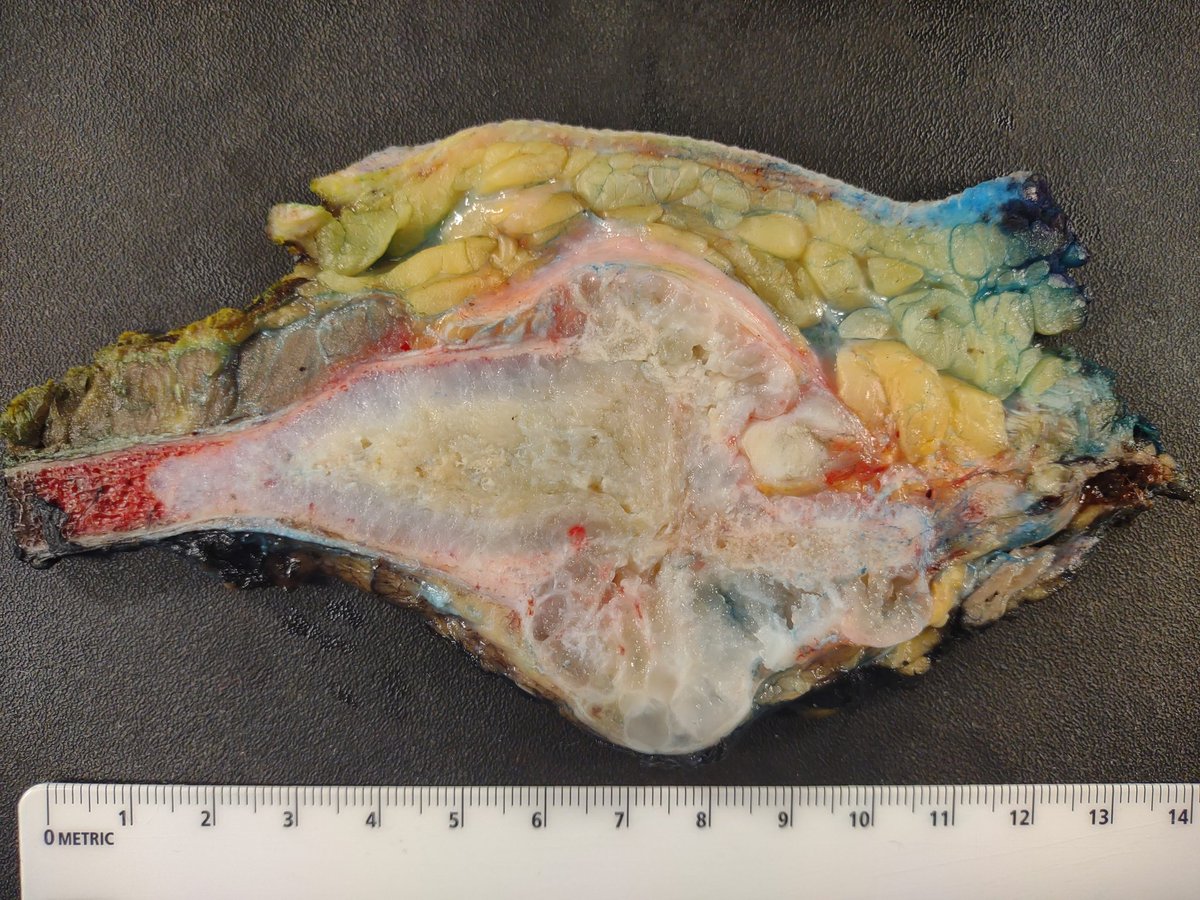 Primary chondrosarcoma of the sternum. Resection includes overlying skin and subcutis , near total sternum with mass and medial aspects of ribs 2-5, pericardium at deep. #BST #PathTwitter #GrossPathonX