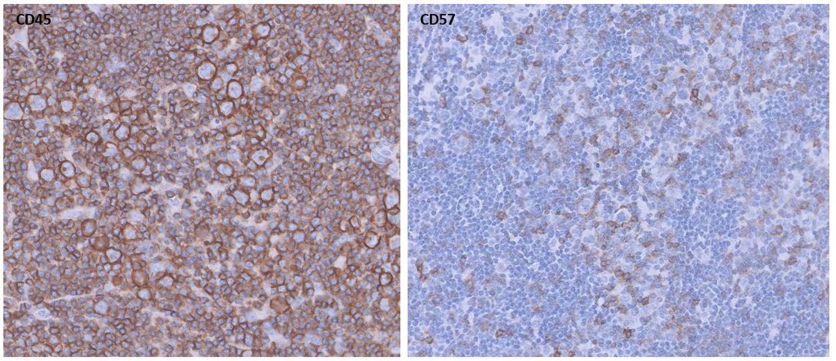 20 year female, submandibular LN. CHL vs NLPHL 
LP cells in NLPHL- CD30-/CD15-
Positive CD20/CD45/Oct2 
CD57 shows Rosetting 
Diagnosed as Nodular Lymphocyte Predominant HL
#hemepath #PathTwitter #lymphoma
#pathology