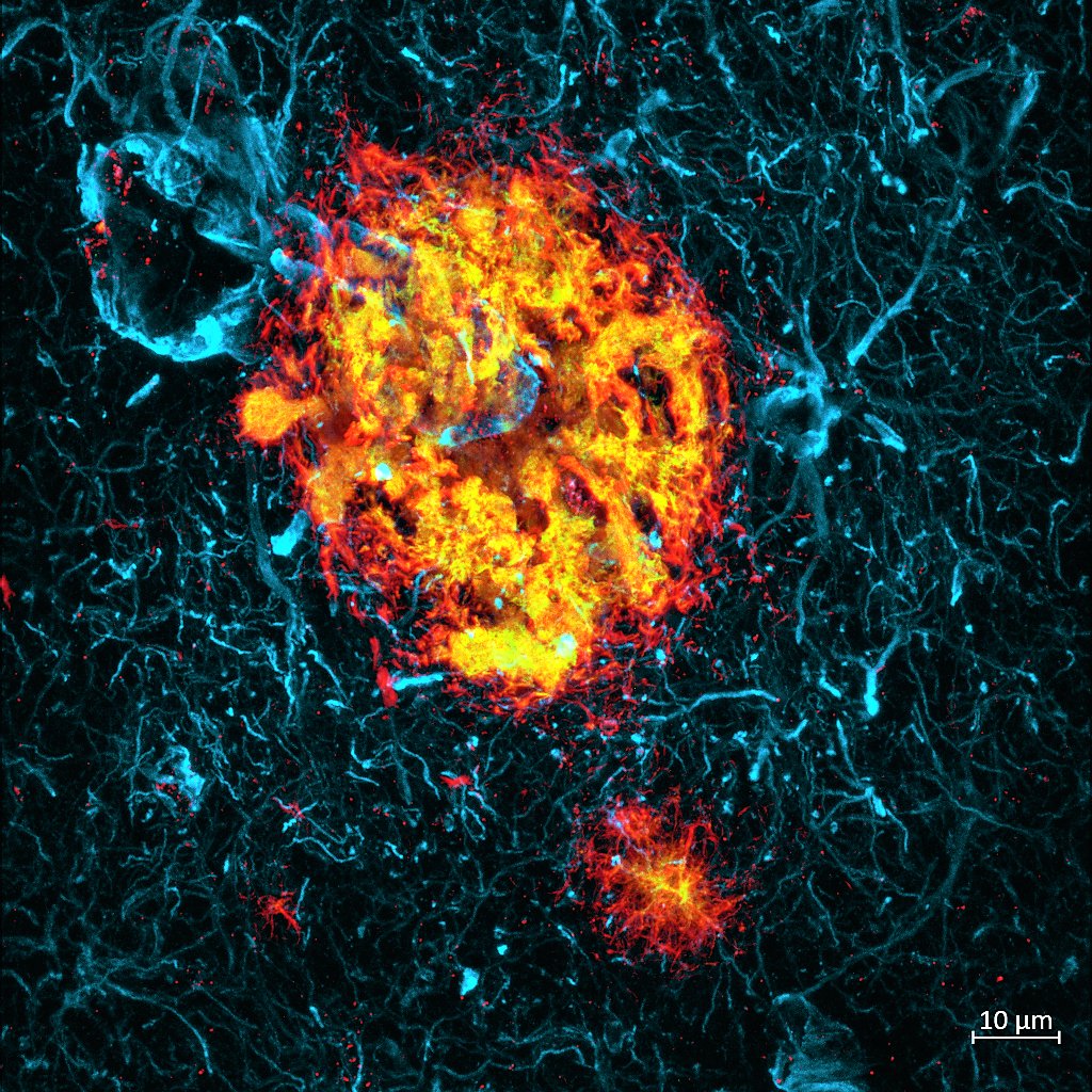 Senile plaques in formation! One of the hallmarks of #Alzheimer's disease pathology, they also occur with normal aging and in macaques. Reactive astrocytes (🔵gfap) and blood vessels are commonly found around it. 2 markers for β-amyloid were used: 🟢D3D2N and 🔴OC #neuroscience