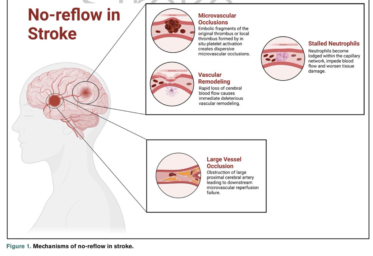 #MondayTip

#No_Reflow

👉Dysfunction of the #microvasculature despite macrovascular #recanalization

Mechanisms:
🛑 Microvascular Occlusion
🛠️(inmediate) Vascular Remodeling
✋Stalled Neutrophils
🚦Large Vessel Occlusion

🔗ahajournals.org/doi/10.1161/ST…
@StrokeAHA_ASA