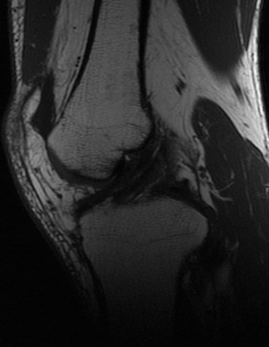 what normal anatomical variant is shown here?🤔
#mskmri #mskradiology
#youseewhatyoulookforandyourecognizewhatyouknow